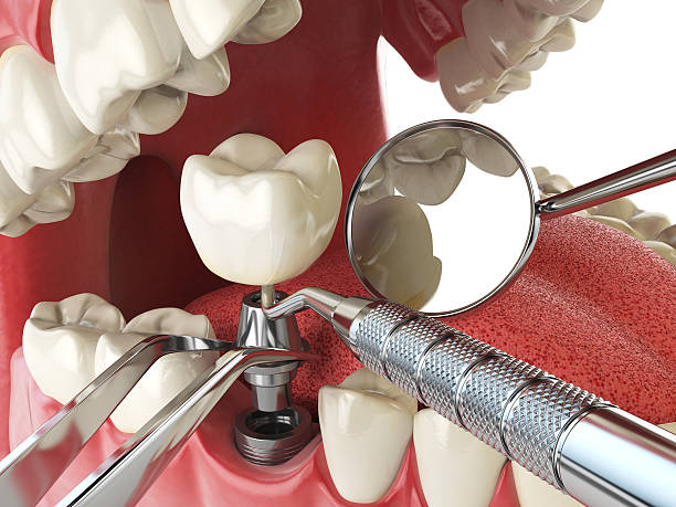 Best Emergency Root Canal Treatment in Hayesville, OR